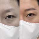 소하동눈썹반영구 후기 눈썹 숱 없는 40대 남성, 헤어스트록 후기