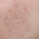 자연드림한의원 | 방학동 한의원 아이스픽 흉터 새살침 해결 가능 케이스 특징