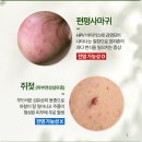 고운여성의원 | 편평사마귀 원인, 증상, 치료 및 주의사항