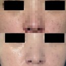 [미용] 내돈내산 로담한의원 부산점 패인 흉터 치료 후기