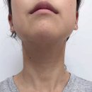 최피부과의원 | 노원여드름피부과 루나크의원과 함께한 치료과정