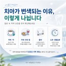 여수치아미백 종류와 주의사항, 여수웅천동치과 바른플란트가 전하는 이야기