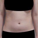 청담슬림의원 | 지방흡입잘하는곳 찾는법? 청담슬림의원에서 알려드립니다