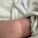 알레르기 | 6개월 아기 신생아 피부염 아토피 알레르기 의원 방문 후기 &amp; 내돈내산 로션