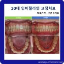 가지런e치과기공소 | 삐뚤빼뚤한 앞니가 고민이라면? 30대 임산부 인비절라인 교정 전후 리얼 후기
