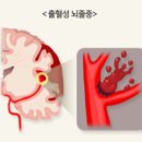 뇌졸중 이미지