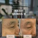 영인터내셔널 | 독일피엠(PM) 어티메이트 영 출시! 3분 즉각 리프팅 + 장기 주름 개선까지 주름지우개