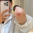 타케팅 | 흑꿈치 몇 번 받아야 하얘질까 | 팔꿈치 피코토닝 색소침착 추적기 (+내돈내산)