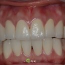 중원치과기공소 | 치아부러짐, 파절된 치아 살리는 방법은? (수진동치과)