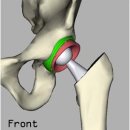고관절 골절, `인공관절수술`로 치료 가능 이미지