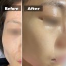 수년째 다니는 인천논현동 지오피부과 앤디야그 레이저 주근깨치료 후기
