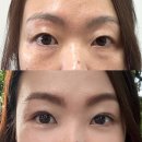 영해약국 | 아몬드성형외과 이인호원장님 자연유착 쌍수 눈밑지방재배치 2주차 상세 후기 (전후사진+통증+붓기)