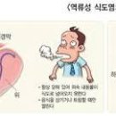 역류성 식도염 원인 과 좋은 음식 이미지