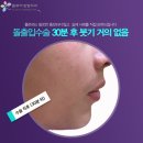플로라성형외과의원 | 돌출입수술후기에 대해 알아보아요 ~!