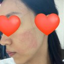 (주)한국바른자세연구원 | 여드름흉터 치료!! 어븀프락셀 후기 (이것보다 더 자세한 후기는 없다)