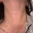 호명한의원 | 대전 둔산동 ( 하늘체한의원 ) 편평사마귀한의원제거 솔직후기 1~7일차