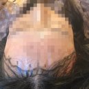 압구정 여자 헤어라인 모발이식 후기 절개 2500모 비용 내돈내산 꿀팁