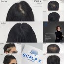 스칼프K 이미지