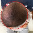 대호상사 | 포항 사두증 아기 헬멧치료 기록#1 경북대병원 성형외과 진료 /대호보조기상사 헬멧 맞춤 후기
