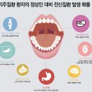 질병 &#34;만성 치주염 Chronic periodontitis&#34; 이미지