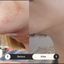 라비에 에스테틱 | 안산 지흡사후관리, 바이오본드와 살처짐 고민? 테라노바 &amp; RF고주파로 끝내세요! (후기가 증명)