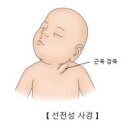 선천성(흉골 유돌의) 사경 (Congenital (sternomastoid) torticollis) 이미지