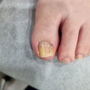 청라맑은숨내과의원 | 수원발톱무좀 효과좋고 빠른 전문관리