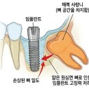 연세선이고은치과의원 | [아산 연세원치과]임플란트, 뒤쪽 사랑니가 수명을 갉아먹고 있다면?