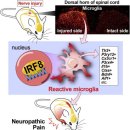 미세아교 세포 overactive - gliopathy 만성통증의 원인... 이미지