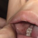 기독어린이집 | 수족구 입원 초기증상과 대처 방법