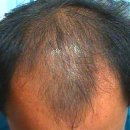 고운빛머리염색 | 춘천여성탈모관리, 조금이라도 나아질 수 있기를 기대하며 두피관리 시작했어요