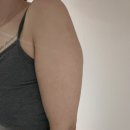 멍이하루 | 팔뚝 지방추출주사 람스 상담 통증 멍 다이어트1주일차 후기