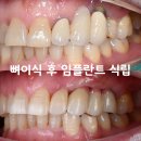 생명나무치과의원 | 브릿지 한 앞니가 아파요, 잇몸뼈가 녹았는데 임플란트 할 수 있나요? 부천임플란트치과
