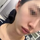 당진피부과 리프팅 ❛텐써마❜ 600샷 받은 후기