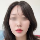 300 | 일산피부과 울쎄라 300샷 후기