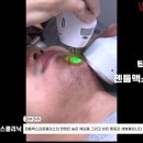 원스의원 | 수원수염제모 젠틀맥스프로플러스 남자 턱인중수염제모 시술동영상 2026/06/18 인계동 원스의원