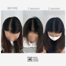 남양주 smp, 남양주 두피문신 스칼프디자인센터 탈모/두피 SMP 1~3차 리얼 후기