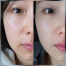 프라임덴탈 | 청담 연예인피부과에서 받은 울쎄라 리프팅 솔직 후기