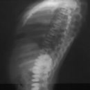 골화석증 (Osteopetrosis) 이미지