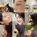 코스팅화장품 | 나의 코재수술 6개월차 후기 !! 코성형준비 이 포스팅하나로 종결 합니다.(코성형 병원고르기 꿀팁++)