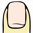 손톱모양