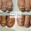 중앙내과의원 | [발톱무좀 3개월] 서울늘봄메디칼내과의원 무좀치료후기 구로 구로역 주블리아 오니코레이저 네일라카...