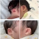 신생아 접힌 귀, 메딧트 귀교정기 내돈내산 후기 및 착용시기