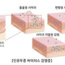 자궁경부암 원인 진단 예방접종 검사 자궁경부 반응성 세포변화 이미지