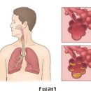 폐렴 초기 폐렴에 좋은음식 예방법 이미지