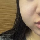 구름발치 | 프로 회피러의 사랑니 발치 후기