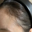 영헤어라인 이미지