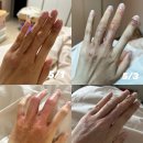 자연치유한의원 | 화폐상습진...자연치유 후기