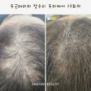 승리미용재료 | 제주탈모관리 솔직 정착 후기, 잦은 모발 빠짐 방치하지 마세요!