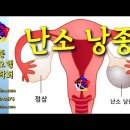 난소낭종 치료 방법 및 사례 - 비과학적 양의학 188 - 사암침, 사암침법, 정통사암침 이미지